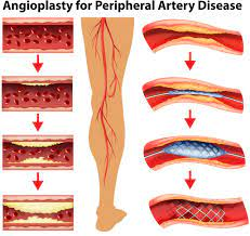 Angioplasty